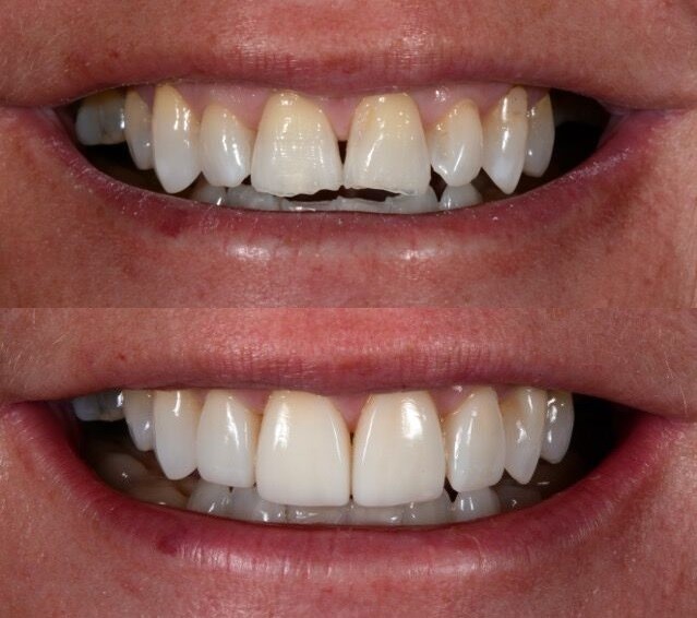 Implants Dentures Harper OR 97906